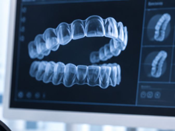 Clear Aligners