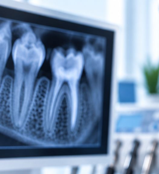 Tooth Extraction