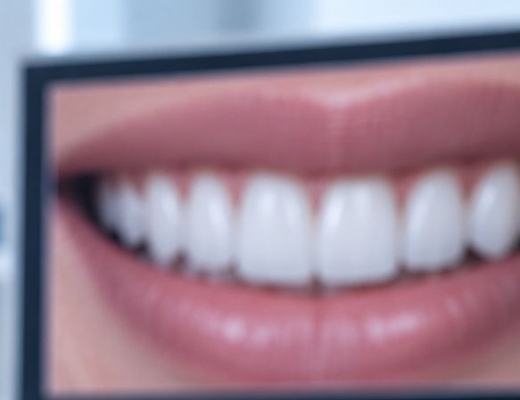 Dental Veneers