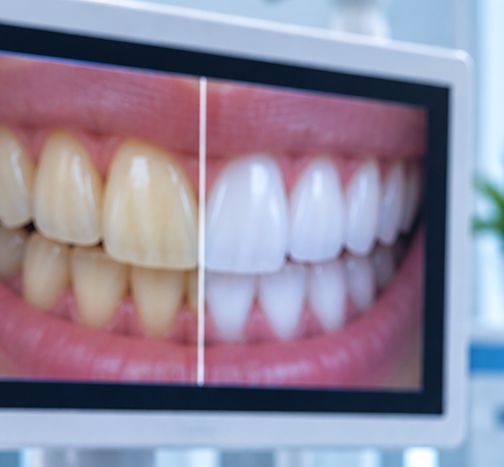 Teeth Whitening